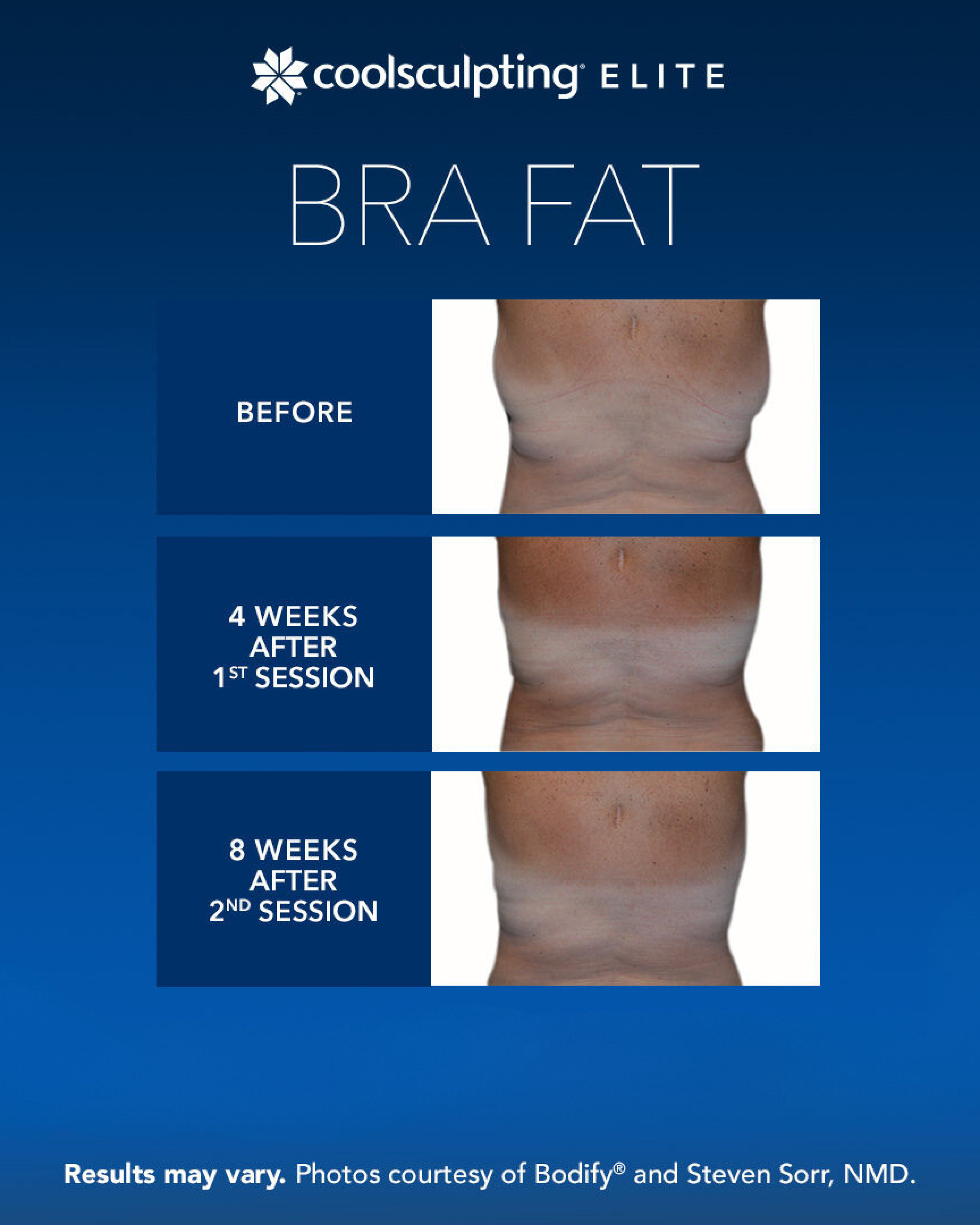 CoolSculpting Elite Bra Fat 1