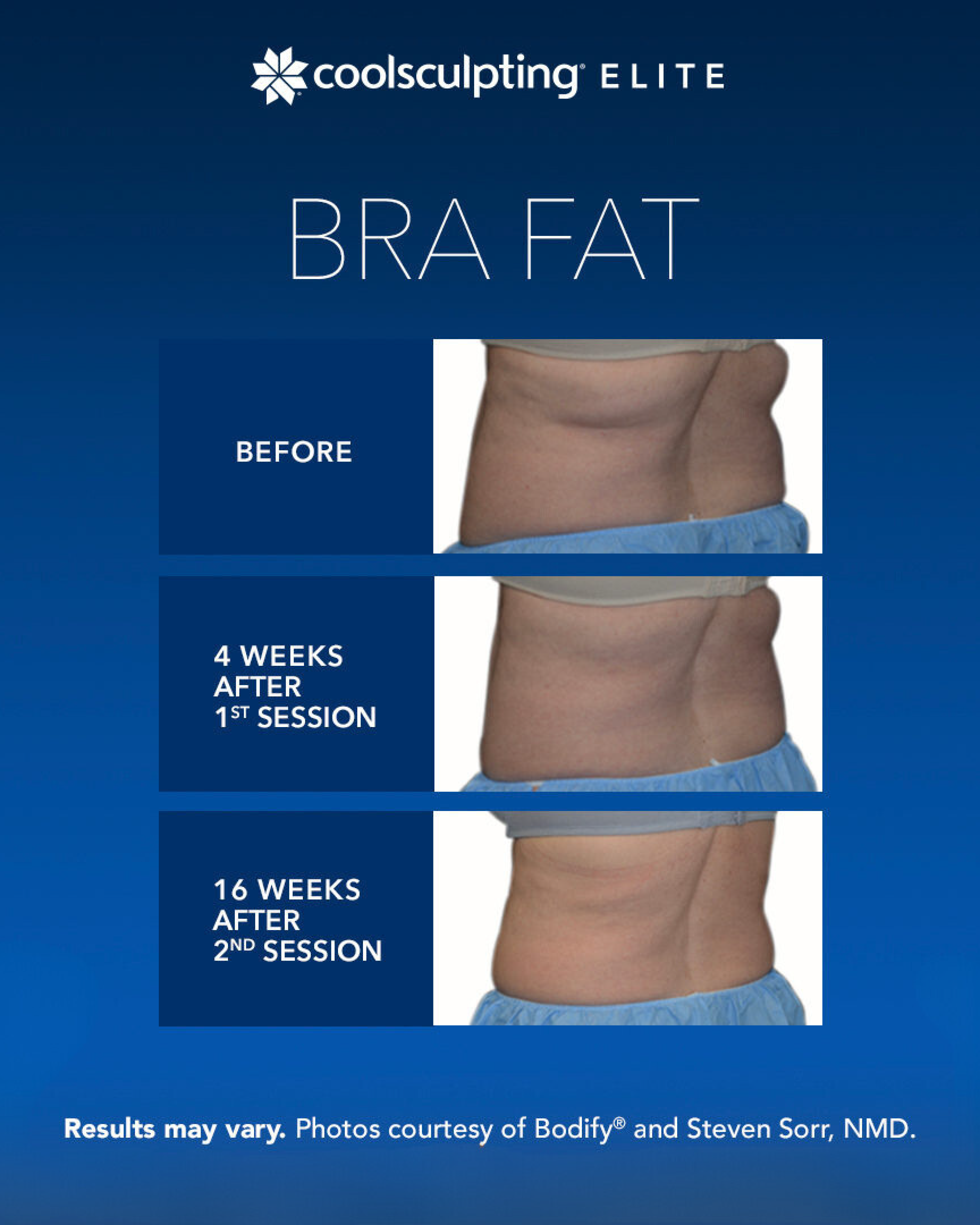 CoolSculpting Elite Bra Fat