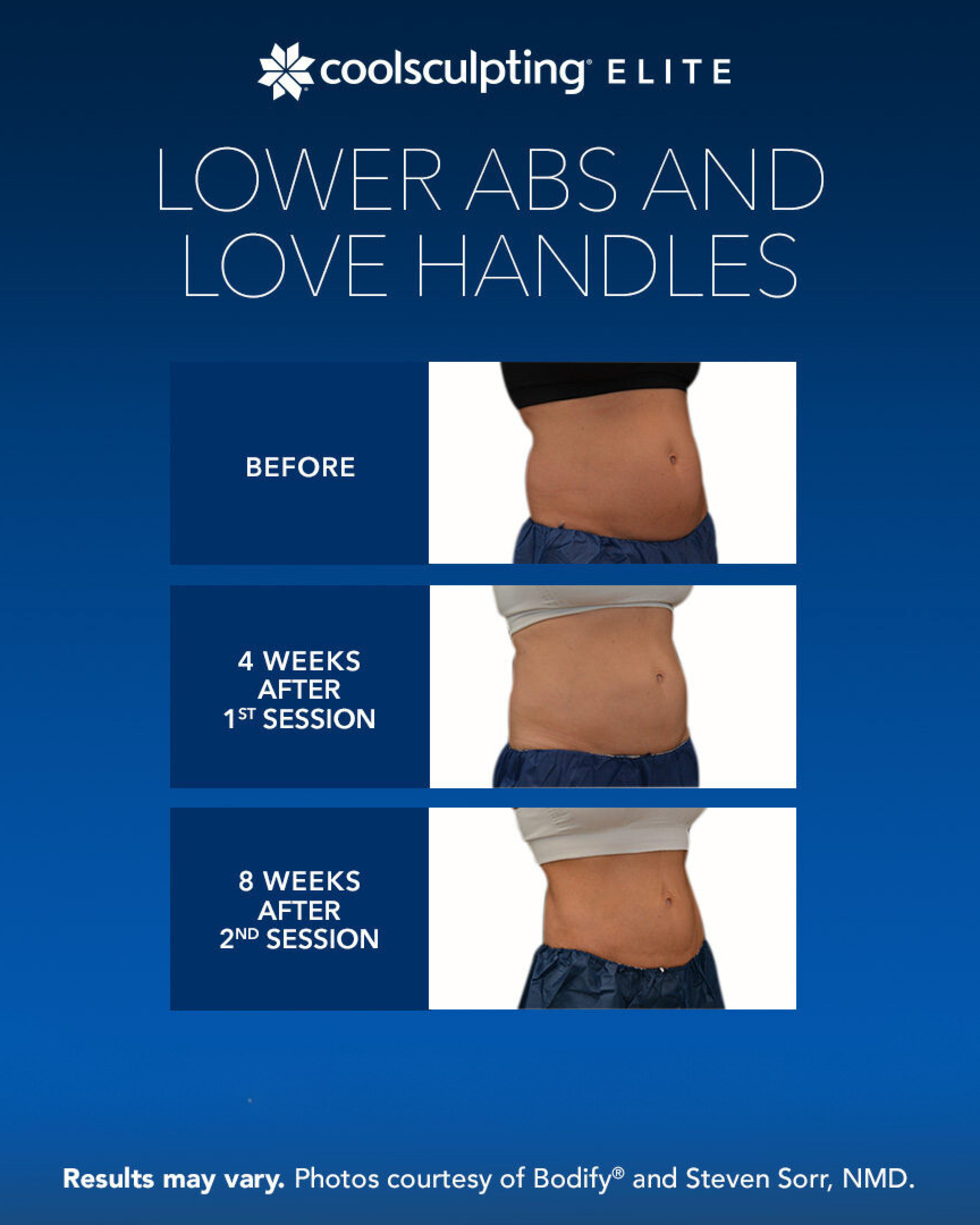 CoolSculpting Elite Lower Abs and Love Handles