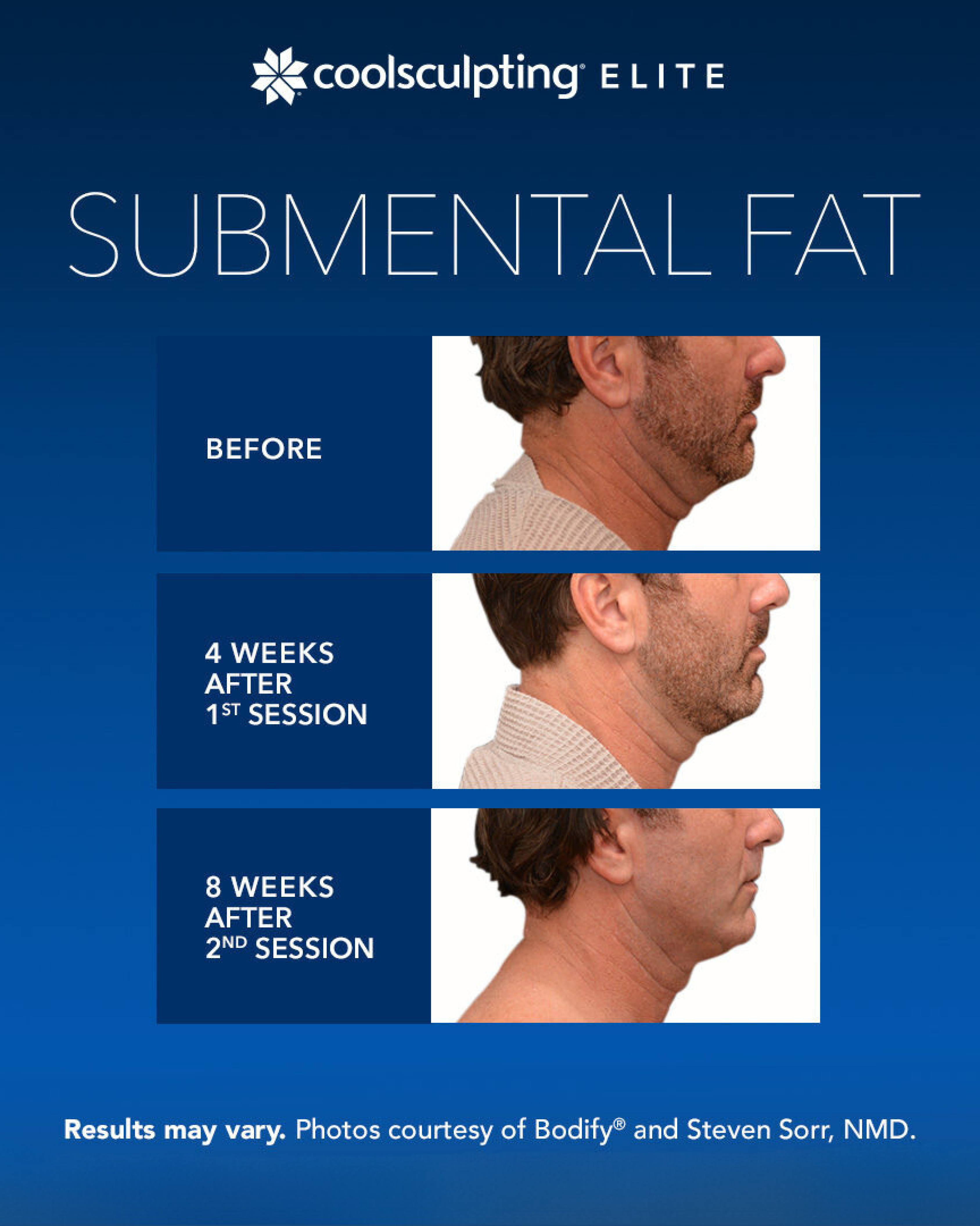 CoolSculpting Elite Submental Fat 1