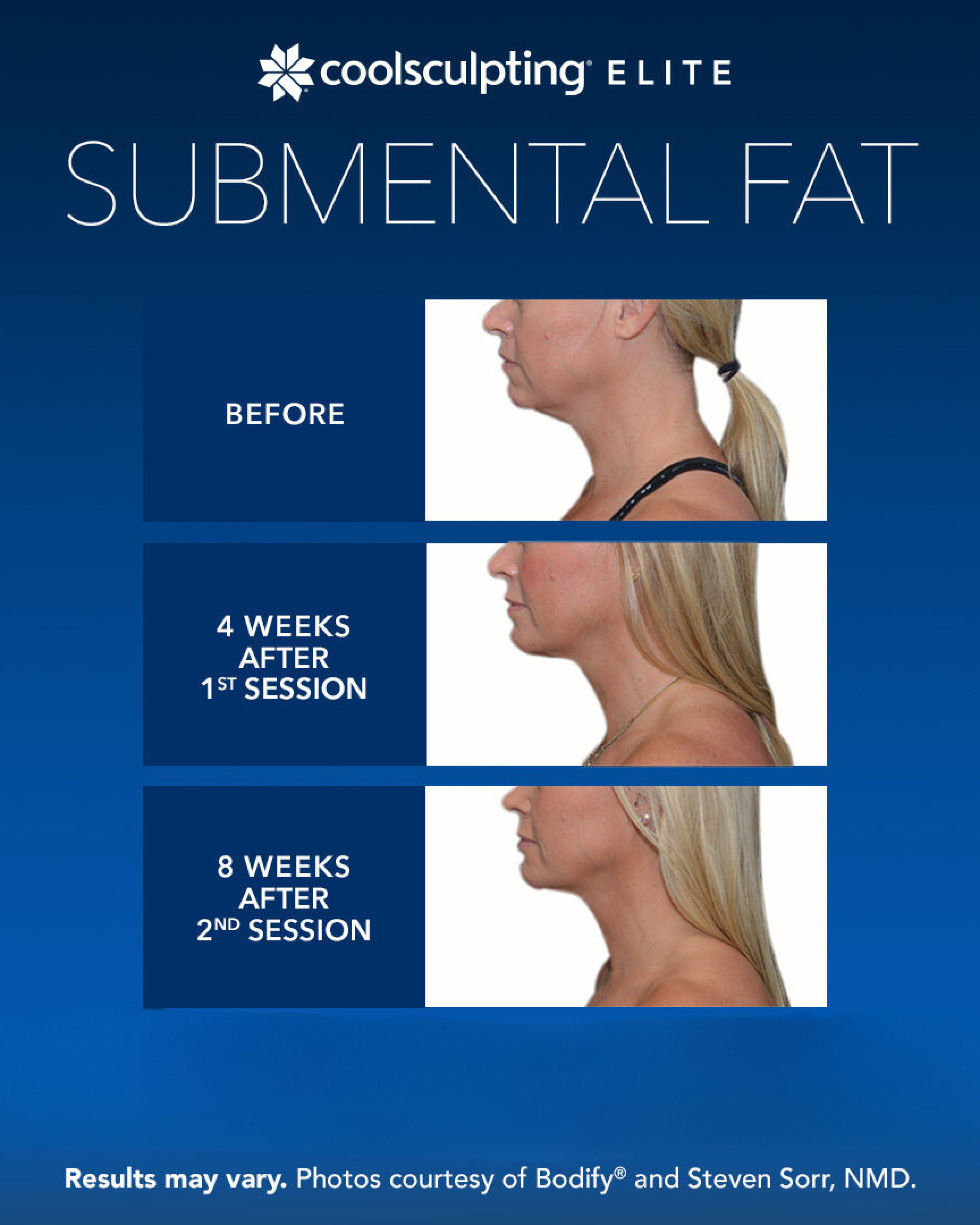 CoolSculpting Elite Eliminate Stubborn Midsection Fat