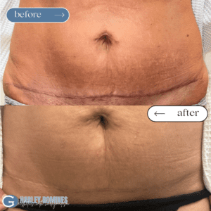 cosmetic procedures knoxville tn, tummy tuck, microneedling, mommy makeover, recovery time plastic surgery